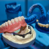 an example of implant dentures from moresmiles dental