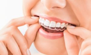 a woman applying dental aligners on teeth