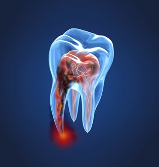 A diagram of nerve pain in tooth